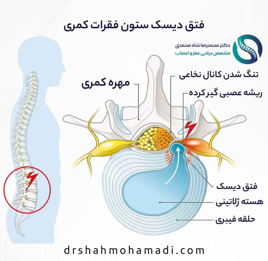 دیسک کمر چیست؟ ساختار فتق دیسک کمر - دکتر شاه محمدی جراح دیسک کمر