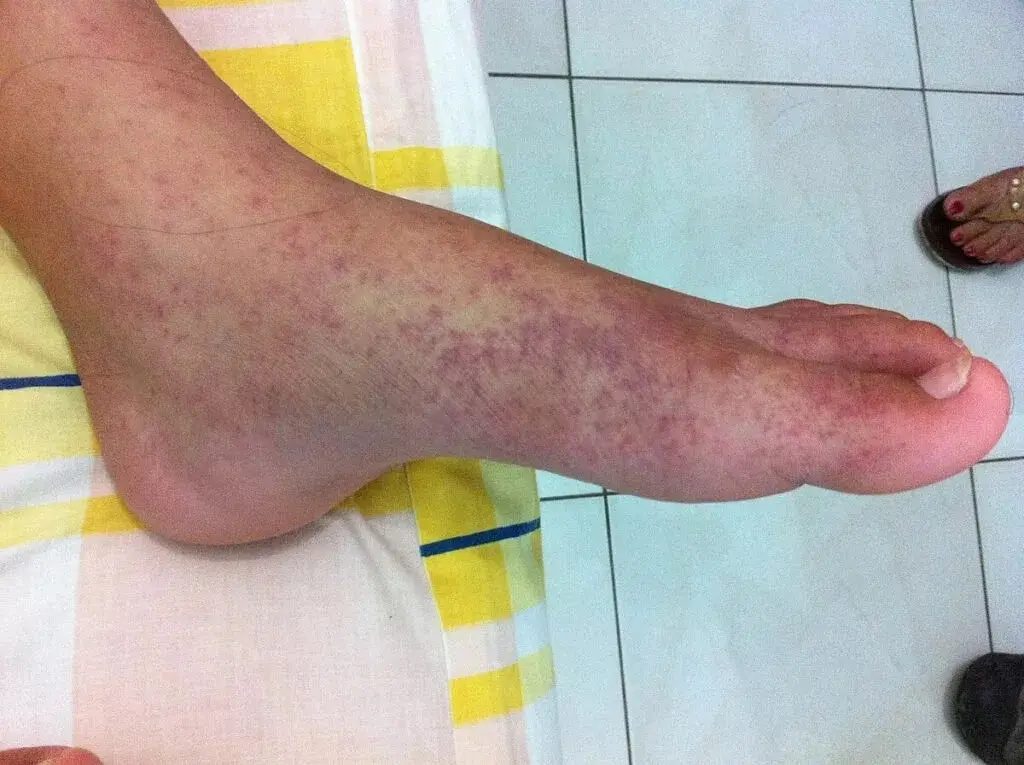 chikungunya1-1024x765