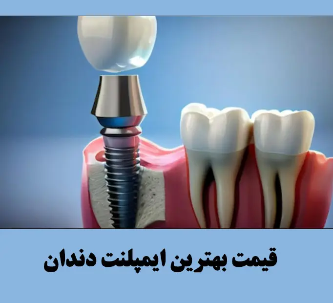 قیمت بهترین ایمپلنت دندان
