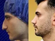 عمل بینی اقساطی در کلینیک زیبایی نورسا؛ ترکیب کیفیت و انعطاف مالی