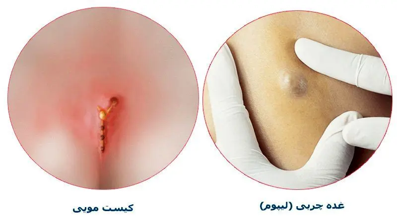 تفاوت غده چربی و کیست مویی چیست؟