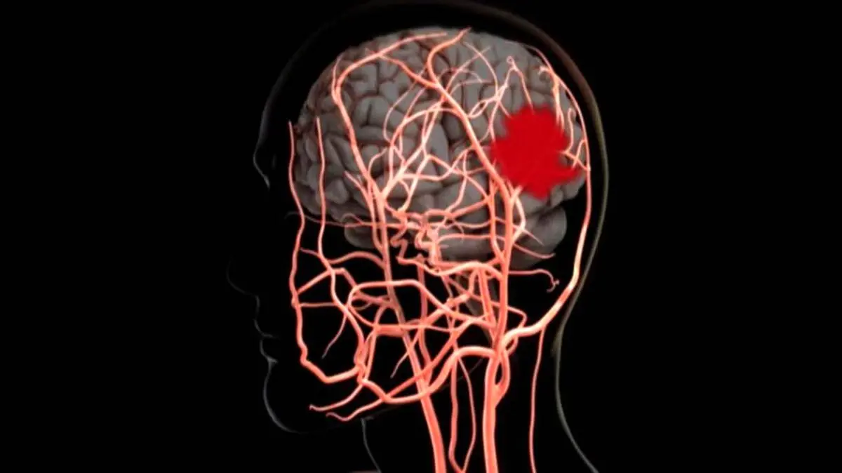 جدیدترین دستورالعمل‌ها برای کاهش خطر سکته مغزی