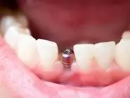 مراحل ایمپلنت دندان چگونه است؟ + قیمت در سال 1404