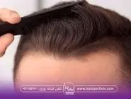 درصد موفقیت کاشت مو چقدر است؟