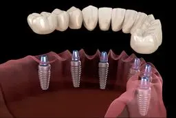 ایمپلنت اشترومن؛ انتخاب اول متخصصان دندانپزشکی در سراسر جهان