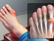 نقرس بیماری پولدارها نیست و همه گروه‌ها را درگیر می‌کند

