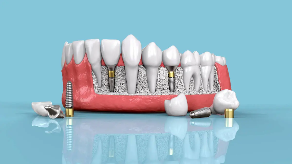 6 مزایای و فواید ایمپلنت های دندانی