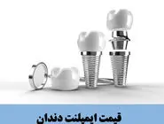 قیمت ایمپلنت دندان