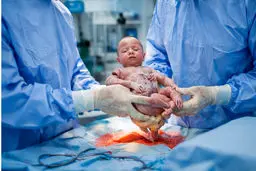 زایمان سزارین در چند هفتگی انجام می‌شود؟