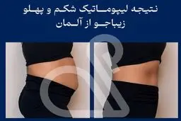 چه کسانی می توانند از روش لیپوماتیک 360 درجه استفاده کنند؟