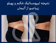 چه کسانی می توانند از روش لیپوماتیک 360 درجه استفاده کنند؟