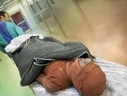 میزان سوختگی در ایران ۸ برابر میانگین جهانی