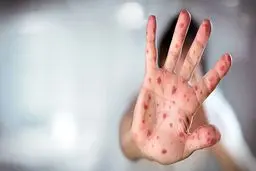 سرخک و سرخجه در ایران حذف می‌شوند