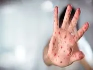 سرخک و سرخجه در ایران حذف می‌شوند