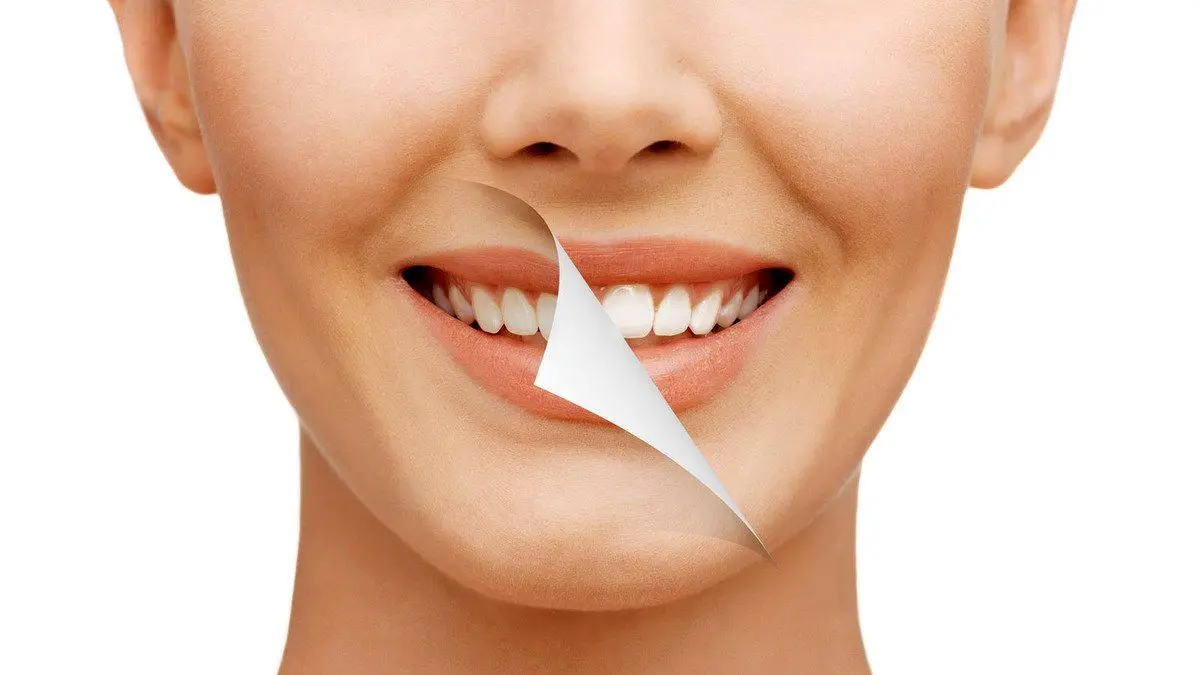 طراحی لبخند با روکش کردن دندانها چگونه است؟