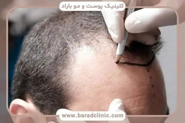 کاشت مو به روش DHI ؛ جدیدترین تکنیک کاشت مو طبیعی بدون تیغ و بخیه